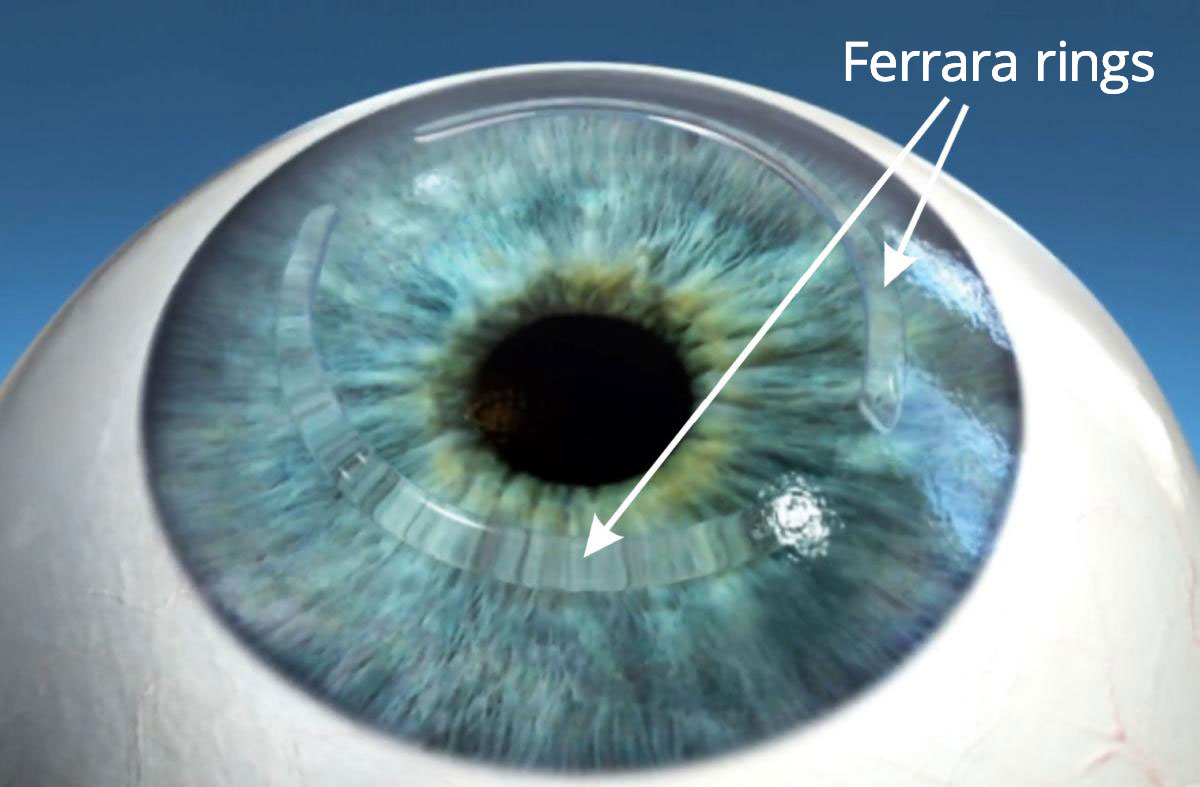 Ferrara ringy iClinic očná klinika - Keratokonus